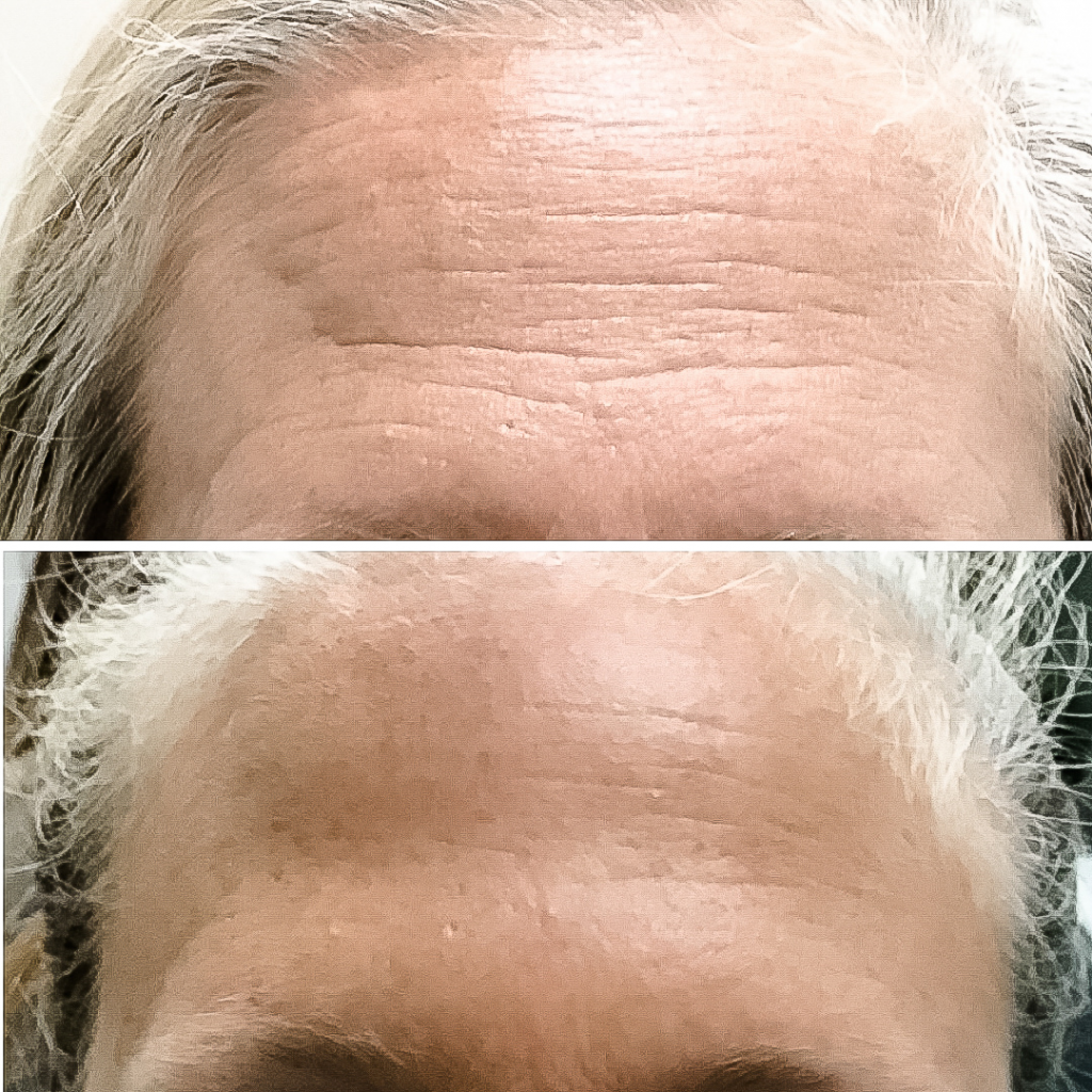 Botox before and after